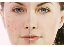 Phác Đồ Điều Trị Thâm